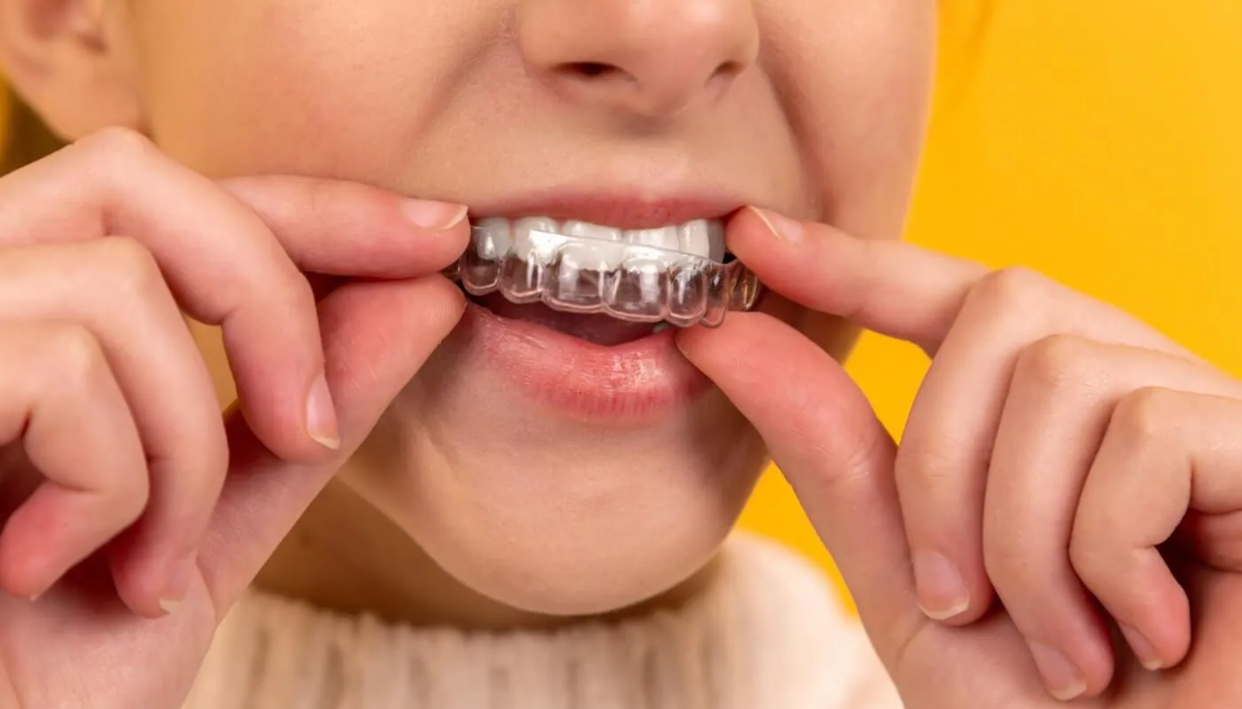 Invisalign – Usynlig tannregulering for voksne og ungdom 2 Person setter inn en gjennomsiktig tannskinne over tennene.