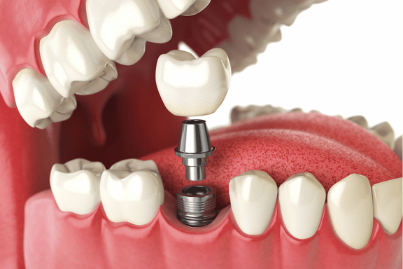 A dentist using computer-guided technology for dental implant planning