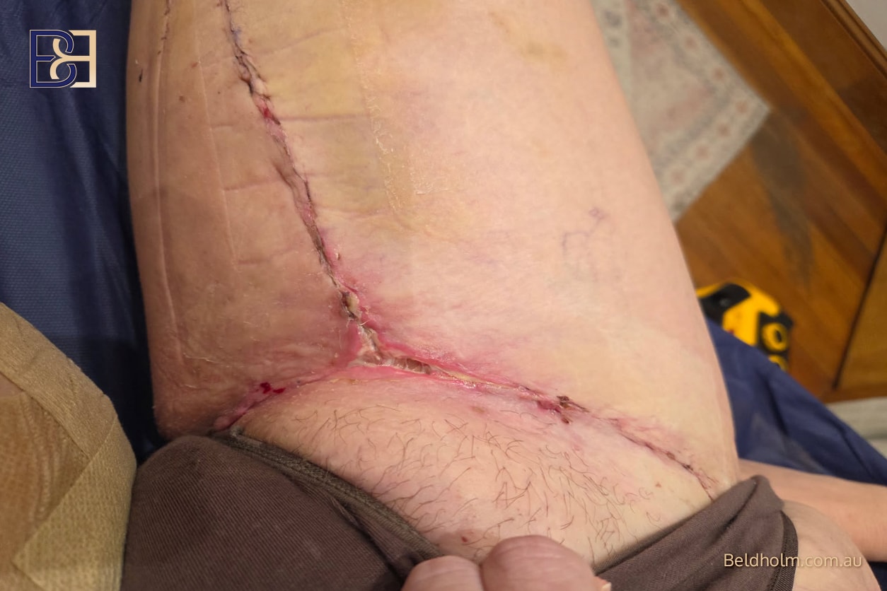 Recovering After Thigh Lift (Thighplasty) Surgery 9 a5e0ccbc 717c 4f12 b78e 59571cab7368