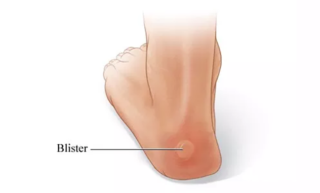 improper footwear, foot pain, foot