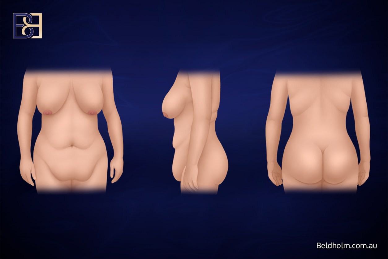 Excess skin after weight loss