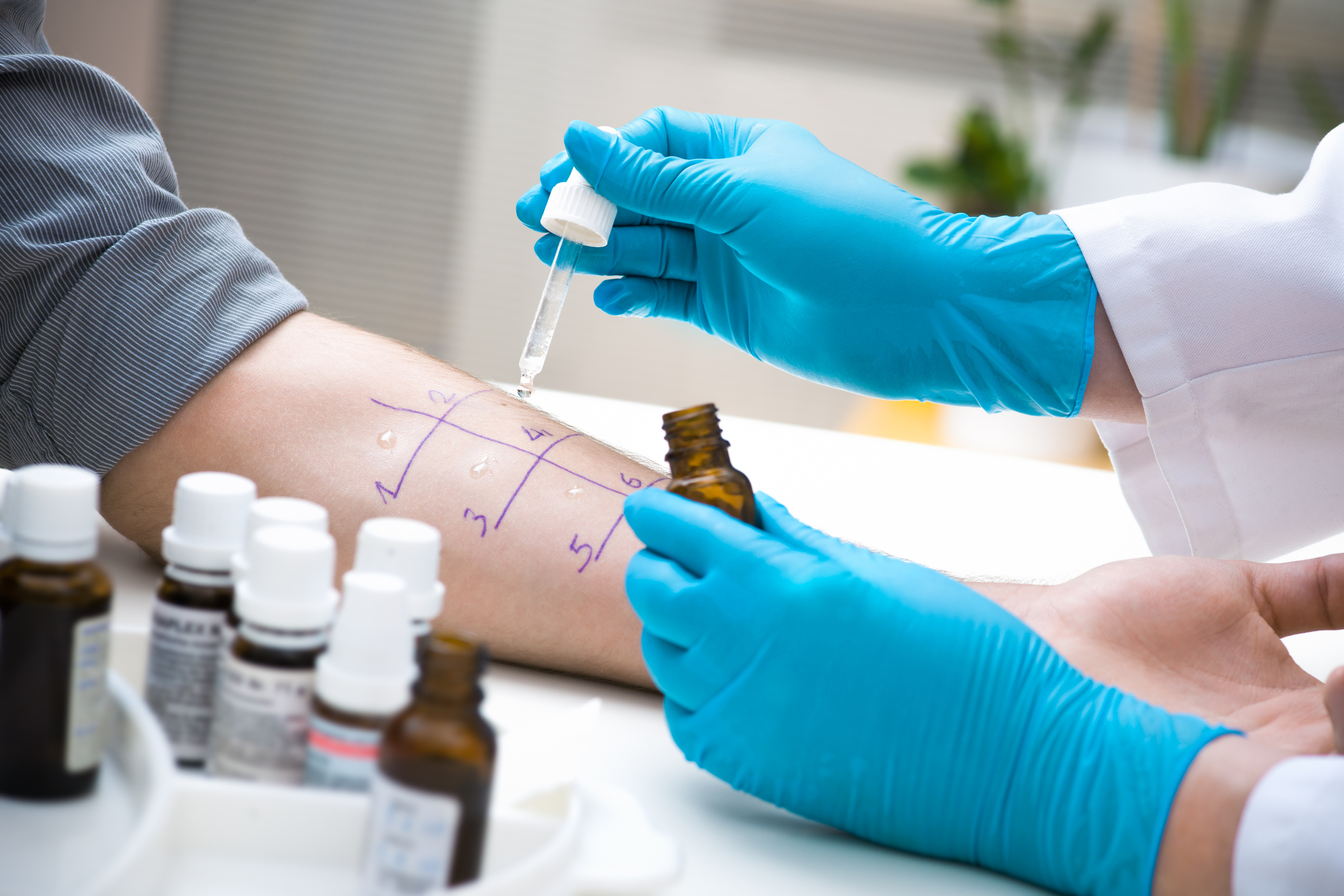 An image of a healthcare provider giving a patient an allergy test.