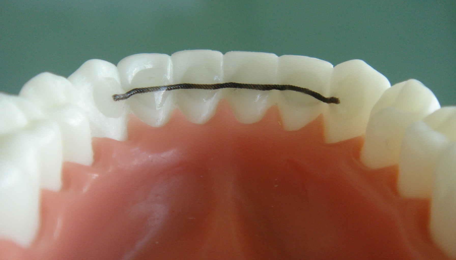 Streng bak tennene løsnet: Hva gjør du nå? 12 Nærbilde av tannmodell med tynn buet retainertråd festet bak de fremre tennene for stabilisering.