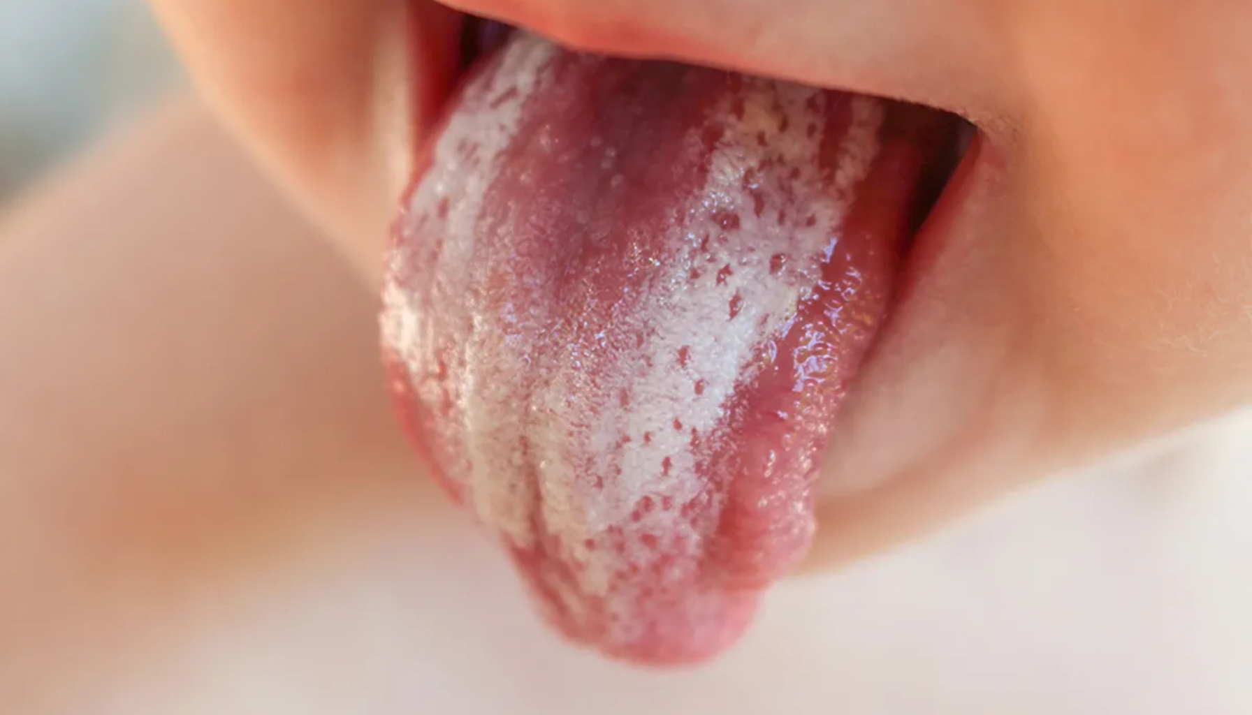 Mycostatin: Når Munnsoppen Trenger Et Tøft Motangrep 13 Tunge med hvitt belegg og røde prikker hos barn, mulig soppinfeksjon eller annen tilstand i munnhulen.