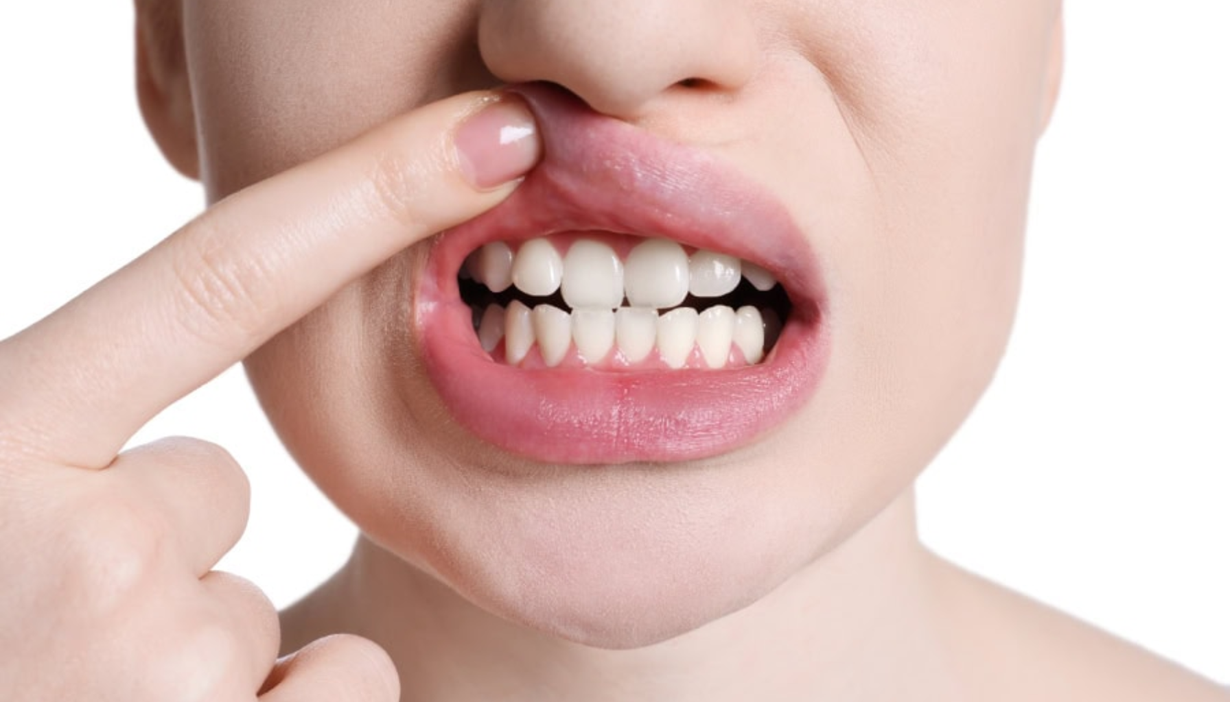 Kvinne trekker opp overleppen for å vise irritasjon og hevelse i tannkjøttet over fortennene.