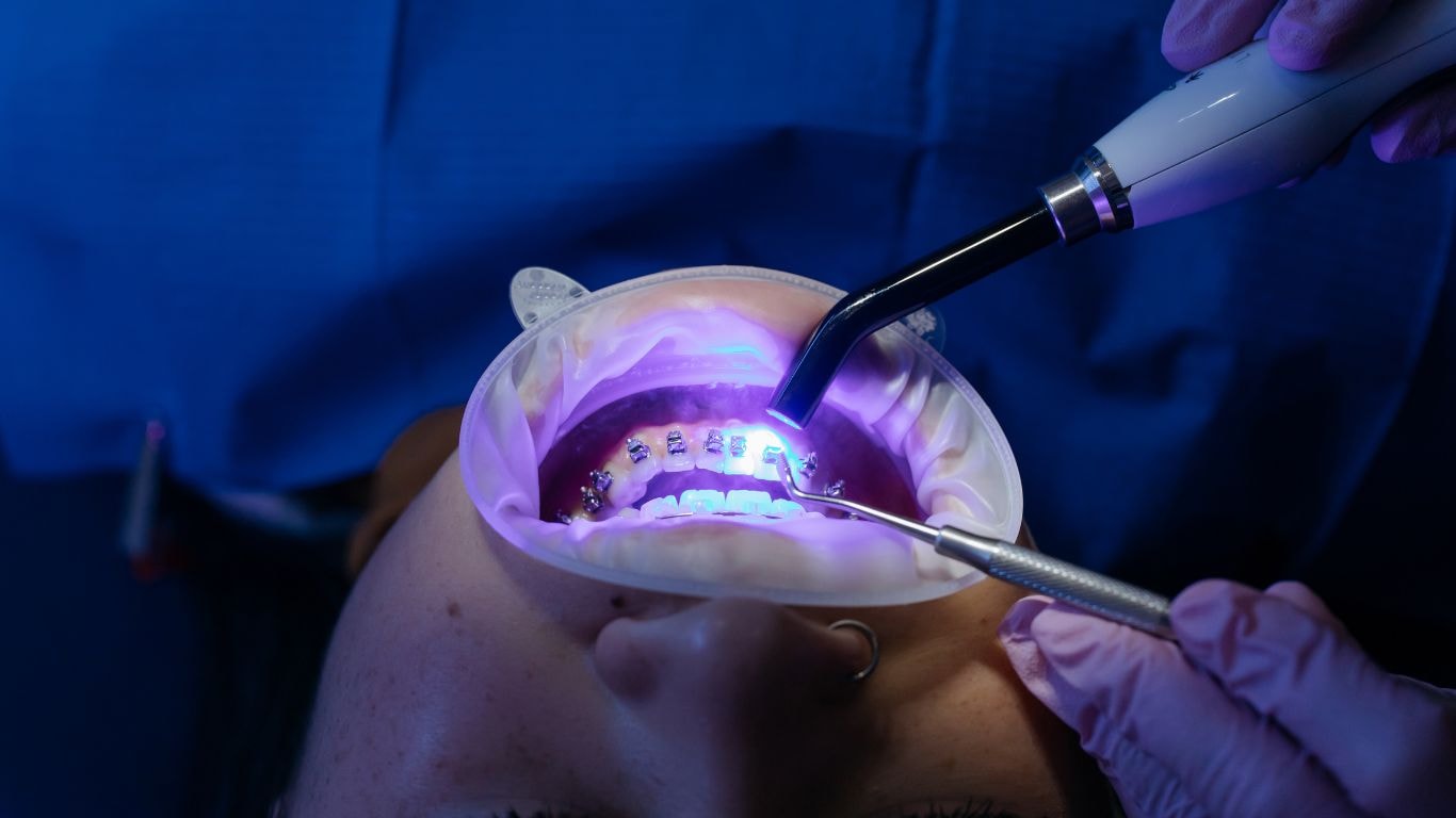yellow stains between teeth
