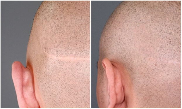 scar concealment before and after