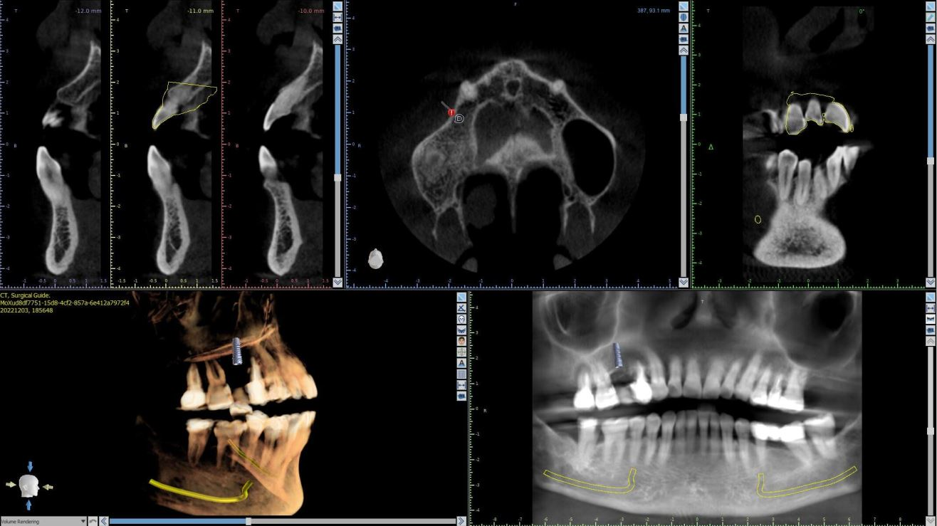 Photo of dental implant surgical placement