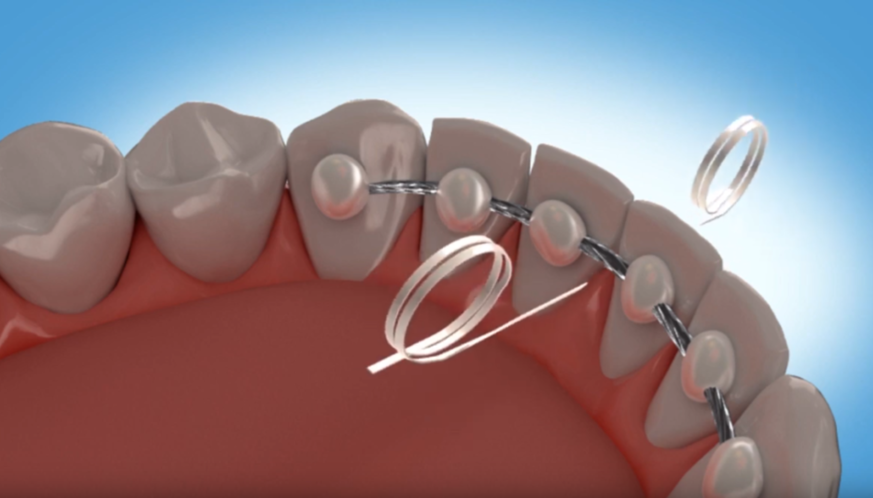 Streng bak tennene løsnet: Hva gjør du nå? 11 Illustrasjon av trådretainer bak tennene der tanntråd føres mellom festepunktene for rengjøring av området. streng bak tennene løsnet bak tennene tennene bak streng strengen reguleringen regulering hos tannlegen løsner løs tannregulering gjøre kjeveortopeden igjen tannlege dersom bruke tannreguleringen hatt løsnet fått plass tenner tilbake behov nye fjerne feste helt vanlig litt baksiden lenge hjelp bruk viktig time får tid hei kontakt går mulig ganger bør første dine beskjed nok behandlingen behandling hjelpe andre holde snart alltid posisjon flytte bort gjennom