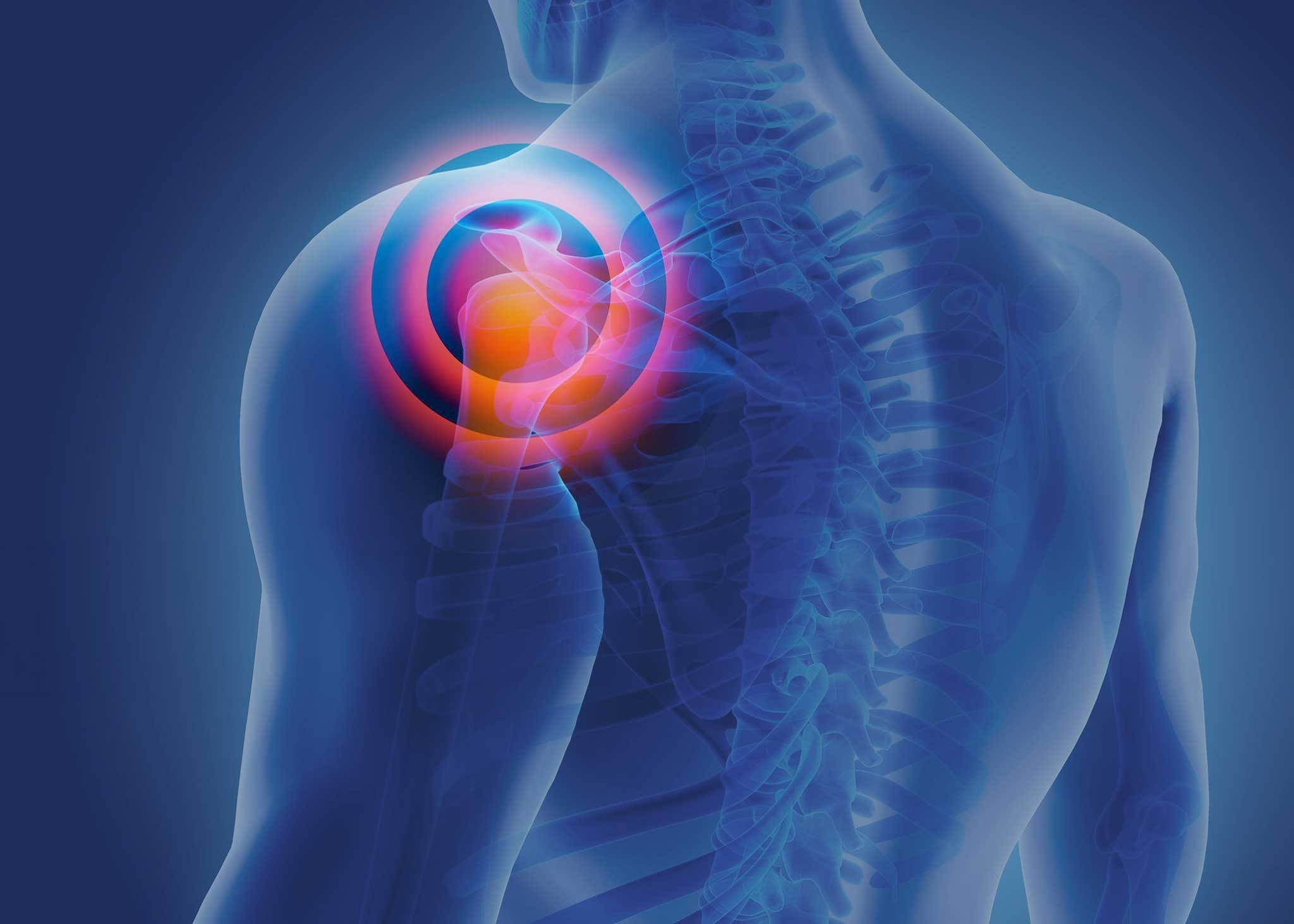 Promieniujący ból barku przy podnoszeniu ręki