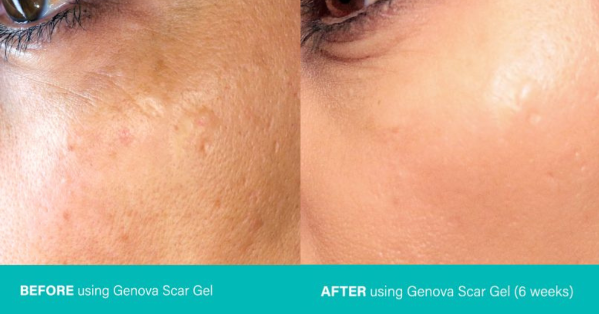 An image showcasing the effectiveness of silicone scar gel through a real-life success story.