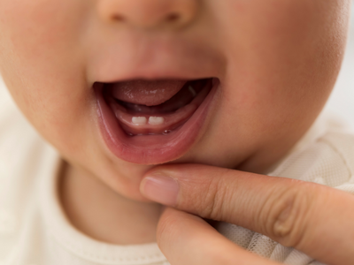 The first teeth - usually the bottom incisors - showing through for a baby