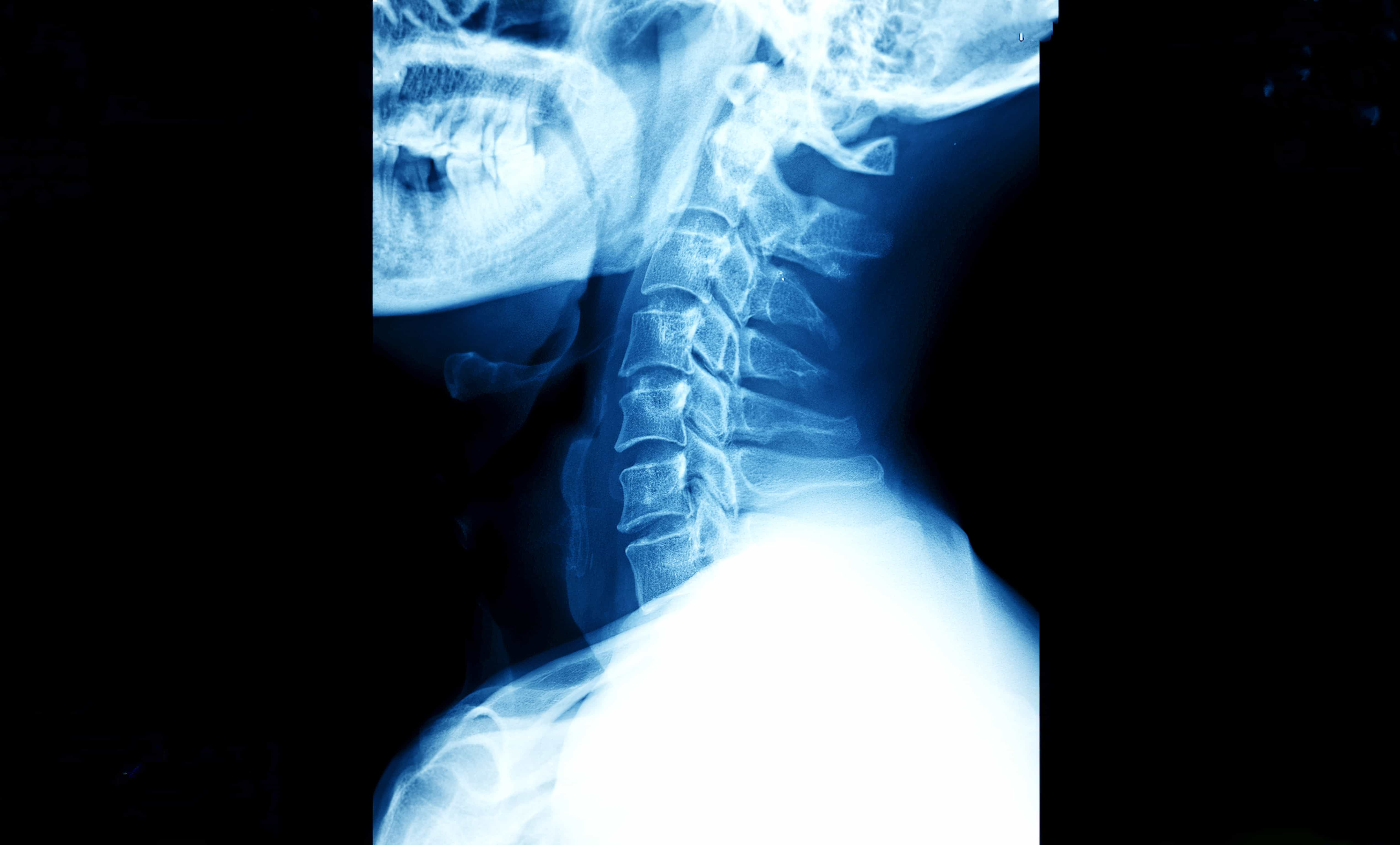 x-ray of a spine looking left