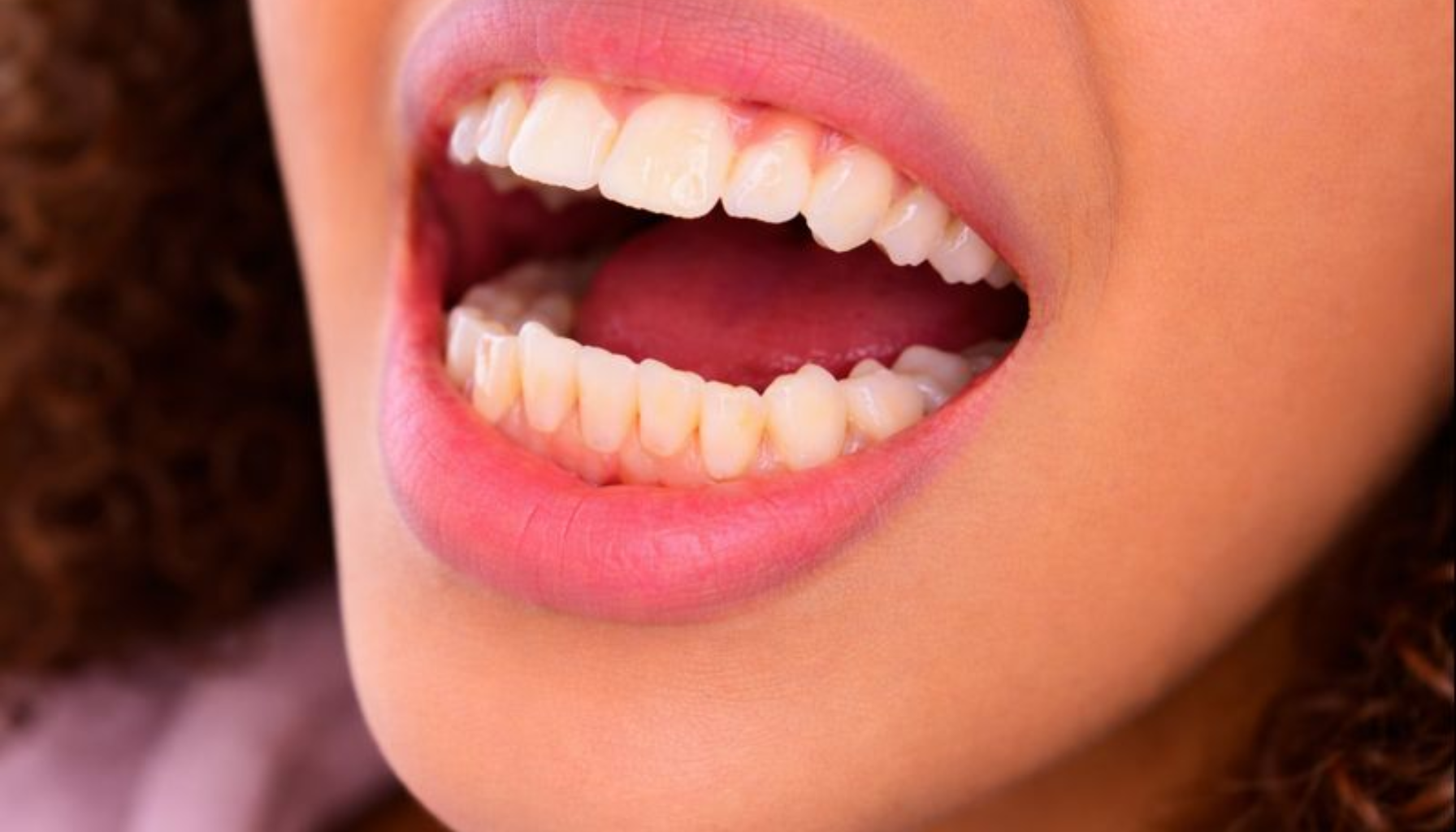 Gom Tenner: Når Tennene Ikke Møtes Som De Skal 15 Åpen munn med lett feilbitt, viser hvordan tenner ikke møtes riktig på en enkel og naturlig måte.