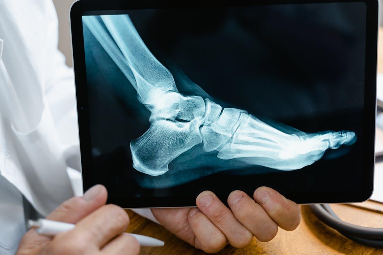 Foot X-ray image used in the evaluation and diagnosis of charcot foot disease.