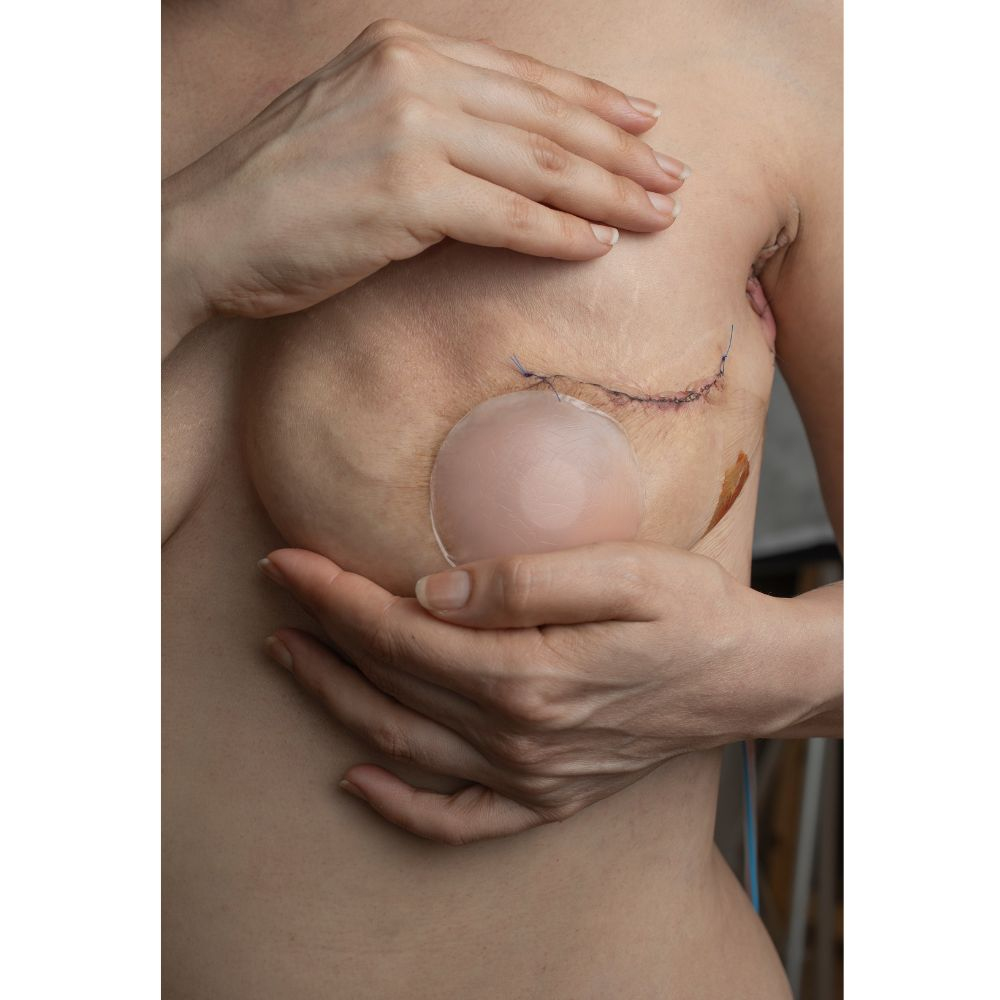 A woman with a post-surgical scar from a breast augmentation