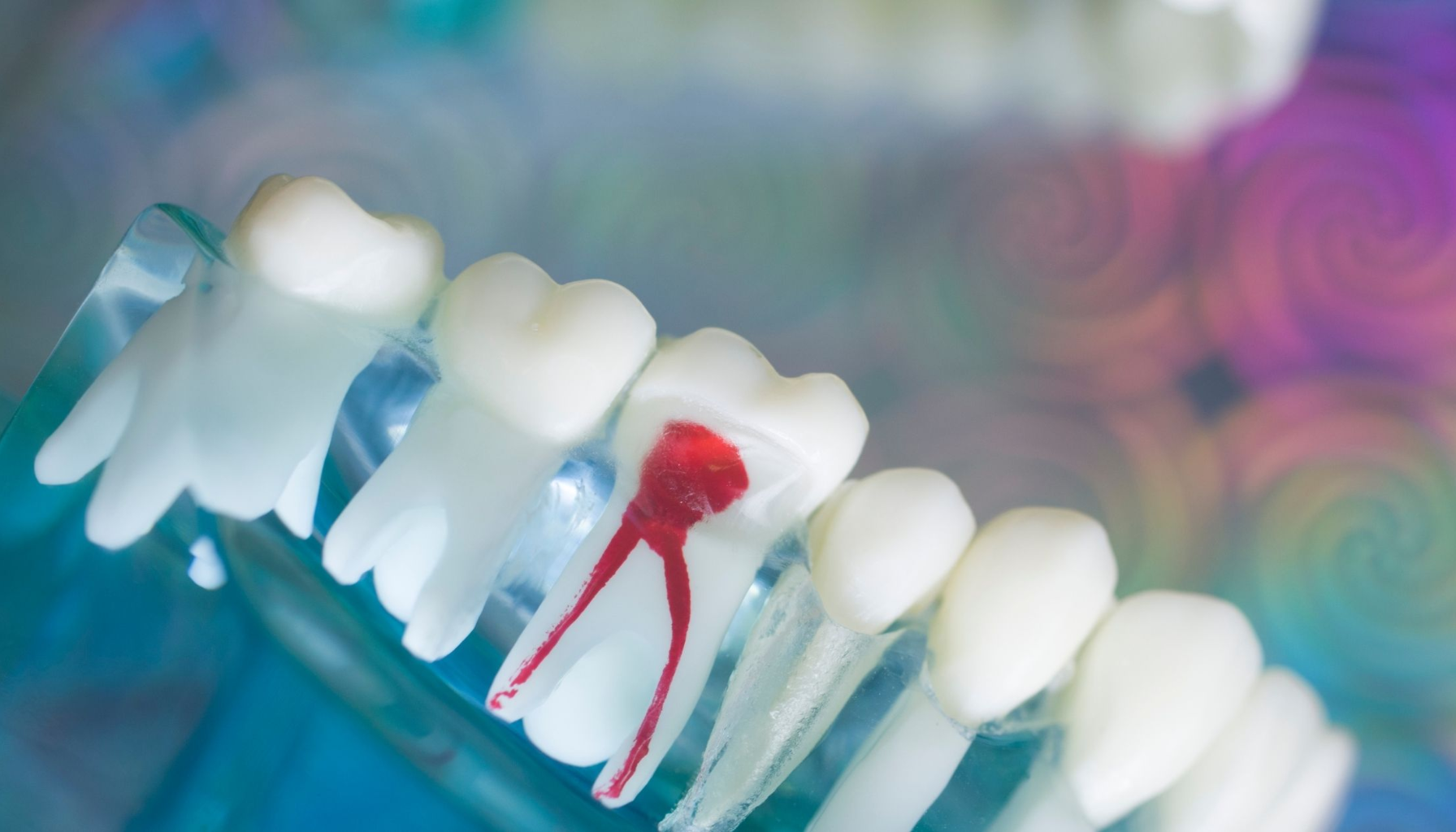 Rotfylling Pris: Hva Betaler Du Egentlig For? (Og Er Det Verdt Det?) 18 Tannmodell viser en tann med synlig rotkanal og betennelse, brukt for å illustrere behov for rotfylling.