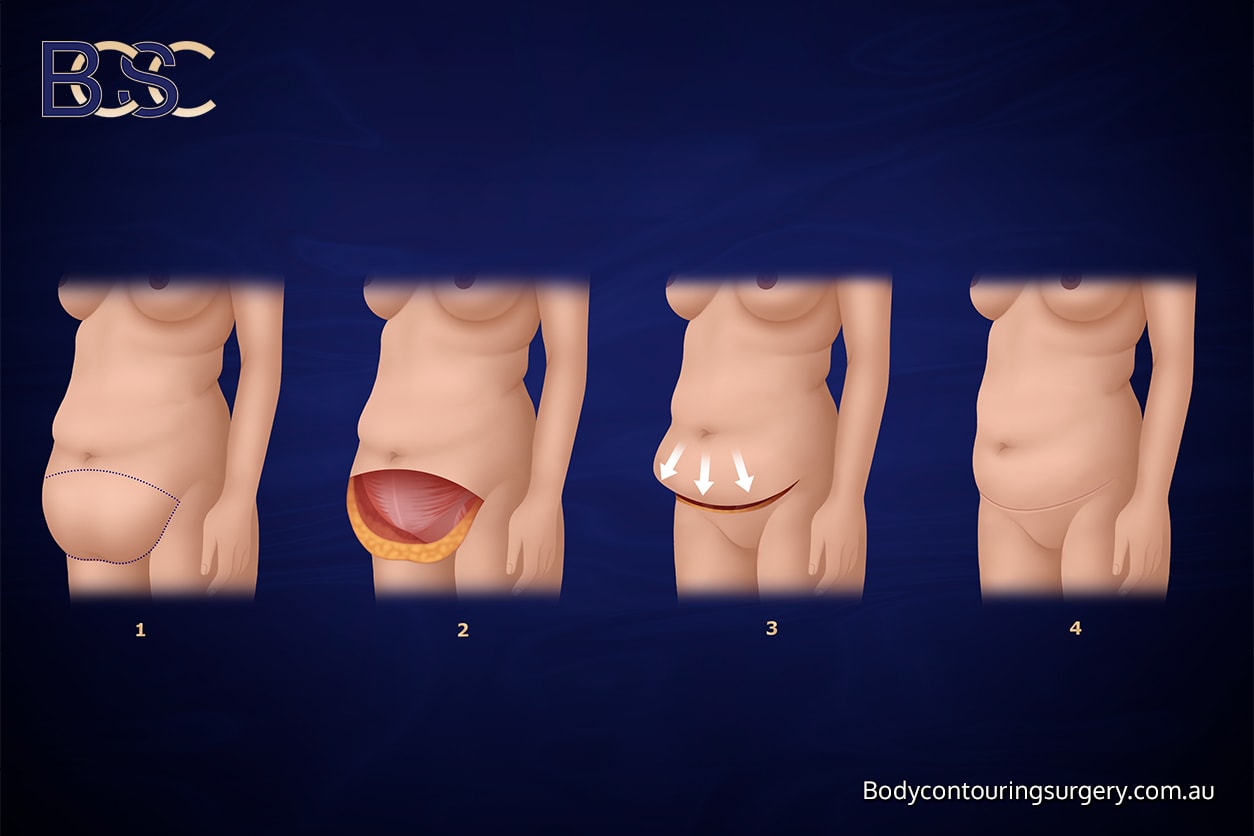 Abdominal lipectomy or apronectomy Abdominal lipectomy or apronectomy