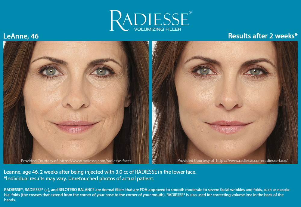 A before and after comparison of a patient who received Radiesse filler treatment.