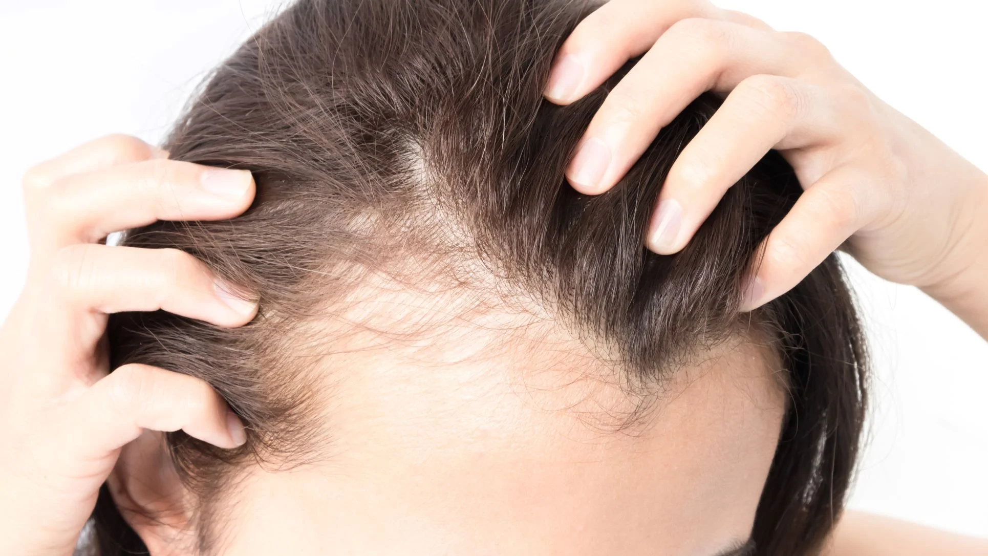 yeast infection on scalp