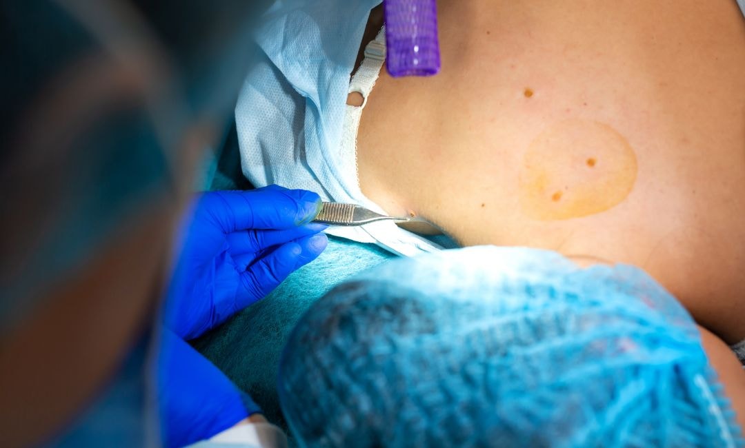 How Moles Are Removed