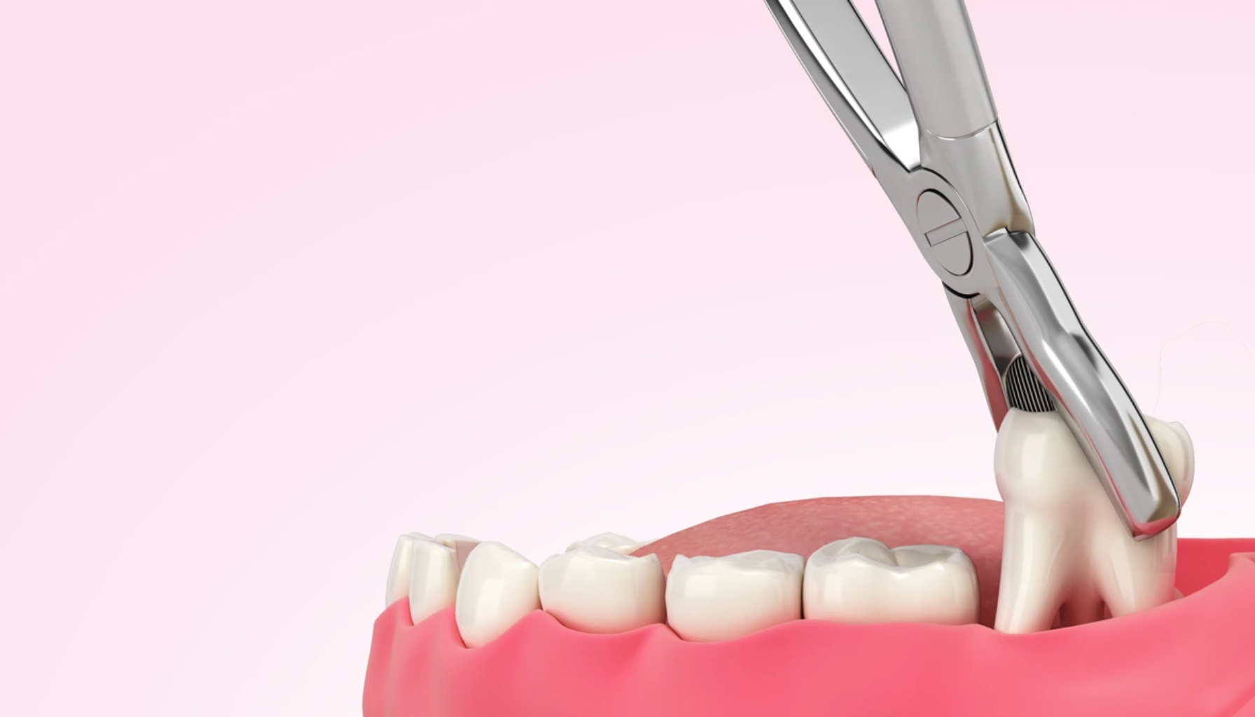 Trekke Visdomstann Pris: Hva Koster Det – Og Hva Inngår? 12 Illustrasjon av en tann som trekkes ut med tang, viser tannbehandling og fjerning av visdomstann.