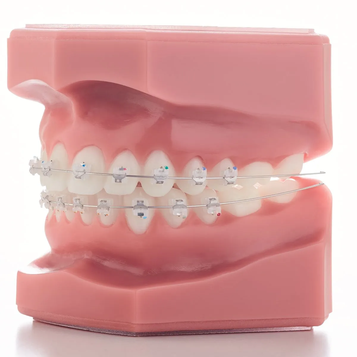 our ceramic braces from Japan