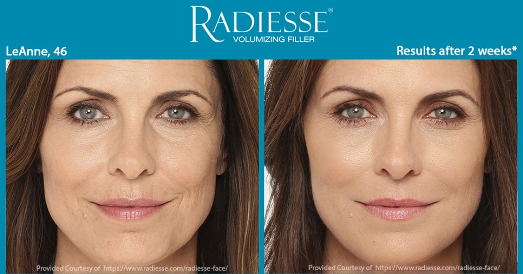 Diferencias claves entre Radiesse y Sculptra en dermatología cosmética.