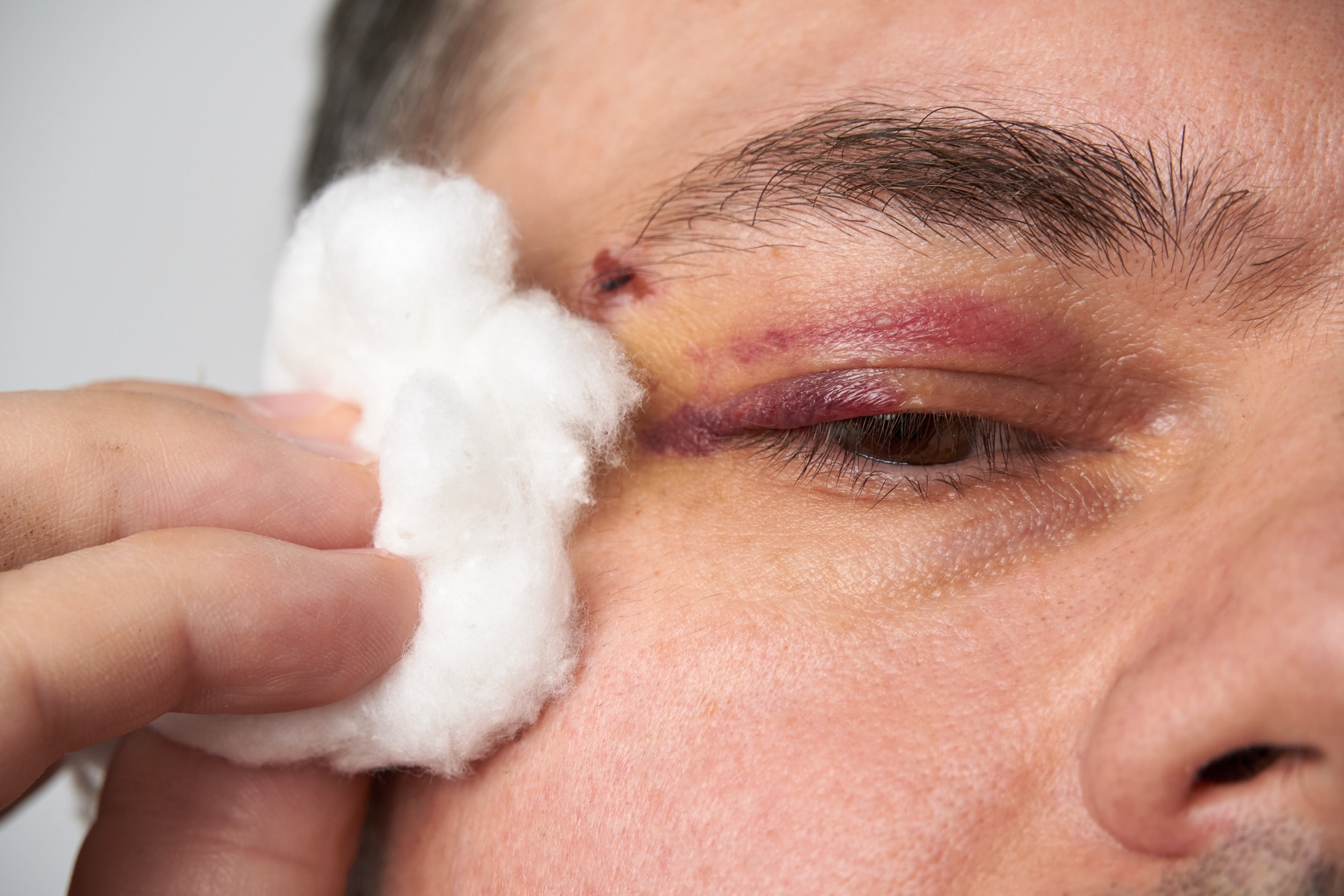 A man holding cotton wool to a bruised eye