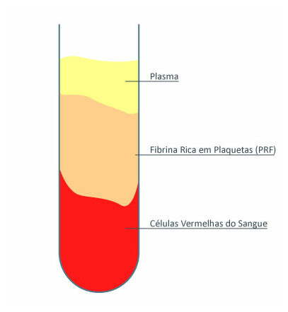 Fibrina rica em plaquetas