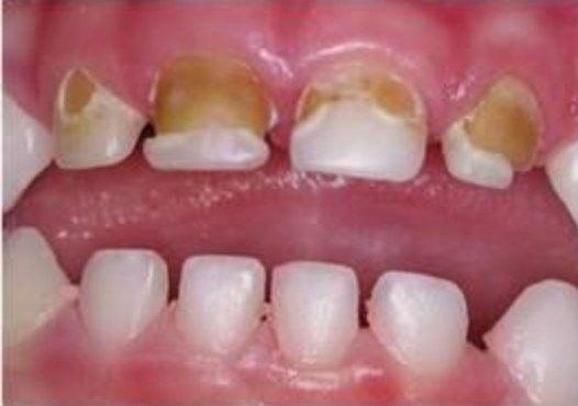 Baby bottle tooth decay