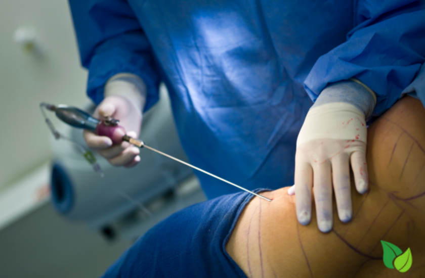 A Doctor extracting excess fat from a woman's  hip area  