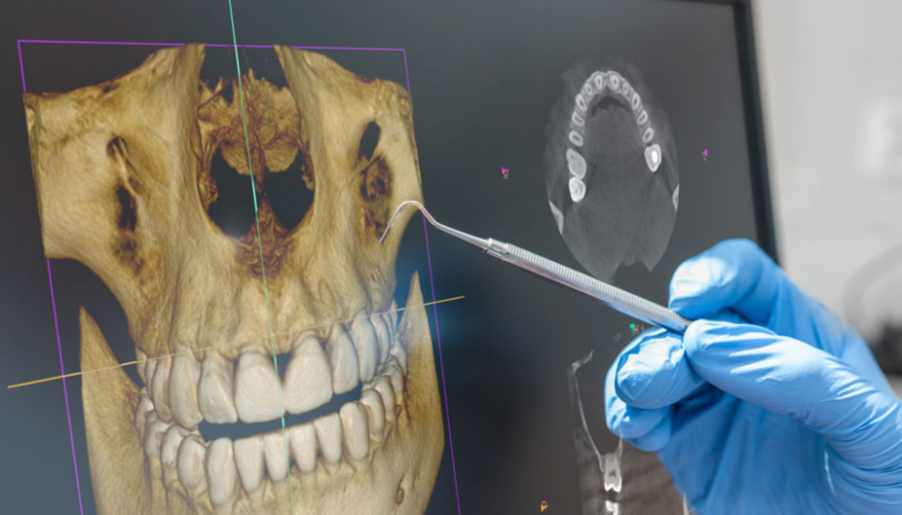 Tannlege peker med instrument på en 3D-røntgen av hodeskalle og tenner på en dataskjerm under diagnostisk vurdering.