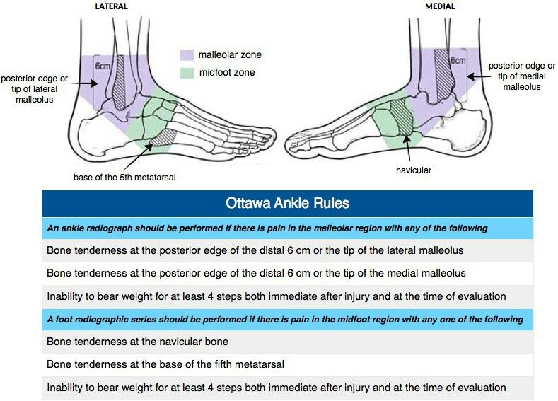 A list of the Ottawa Ankle Rules involving tenderness to palpation and gait assessment.