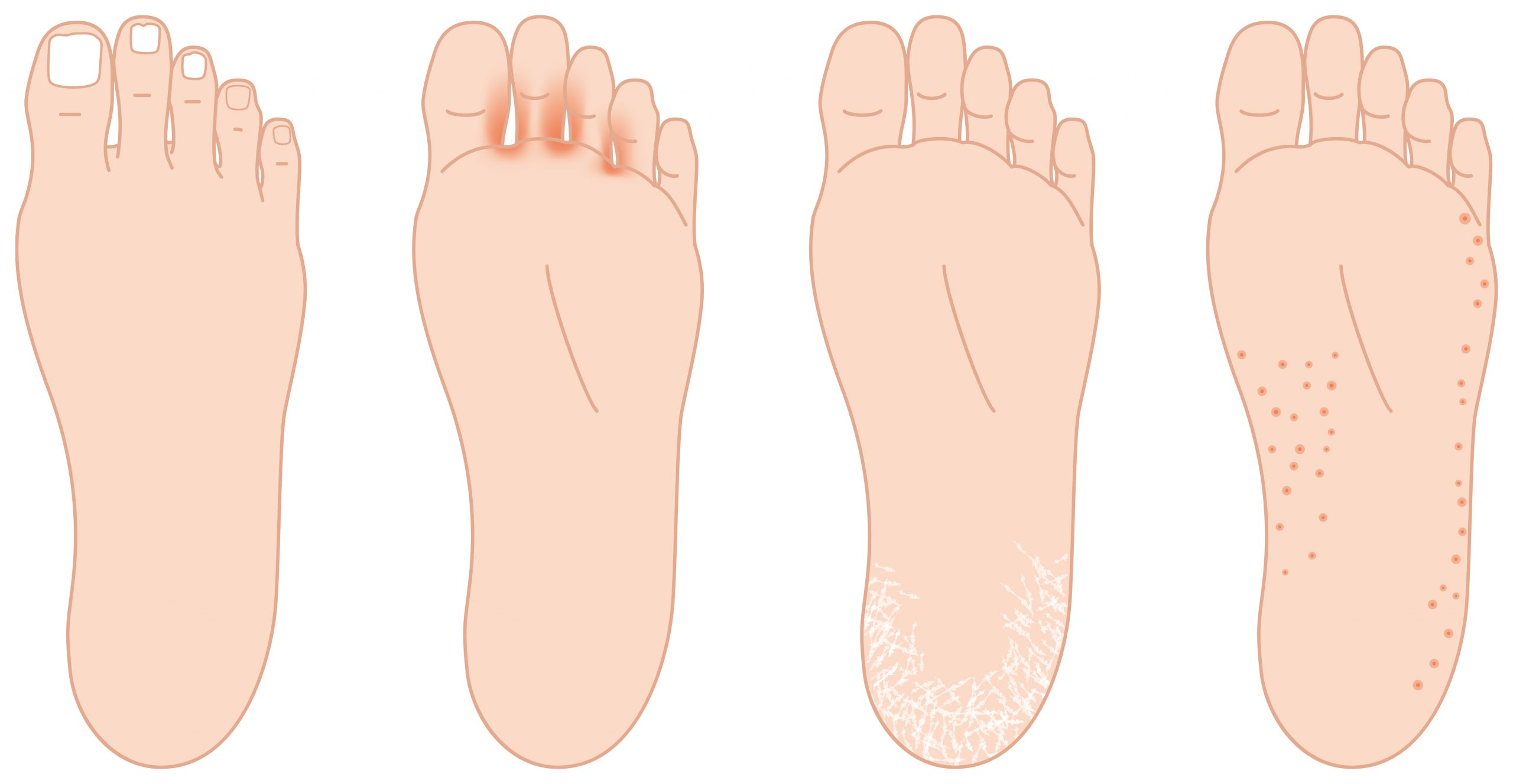 infected skin, moccasin athlete's foot, called athlete's foot