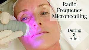 My Radio Frequency Microneedling Experience | the FULL Treatment & the Days  following | Vivace RF MN - YouTube