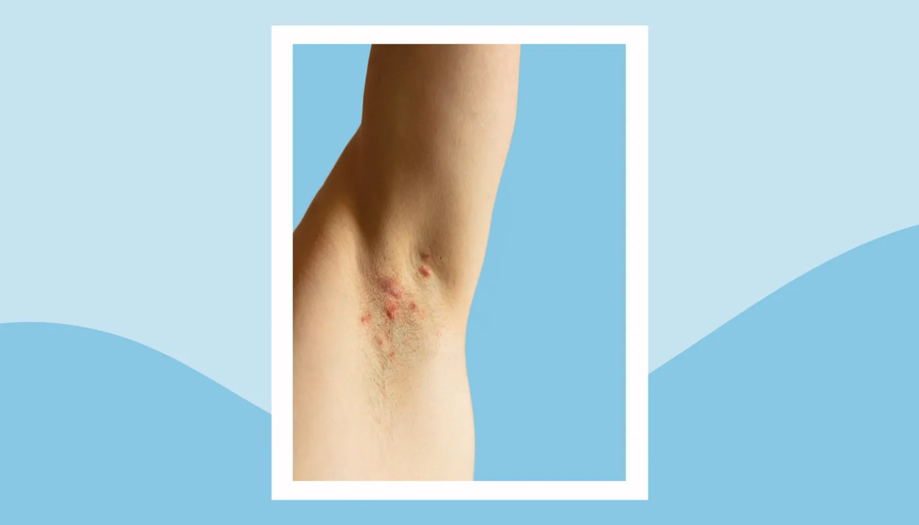 "Rødhet og utslett i armhulen som kan tyde på hudirritasjon eller infeksjon."