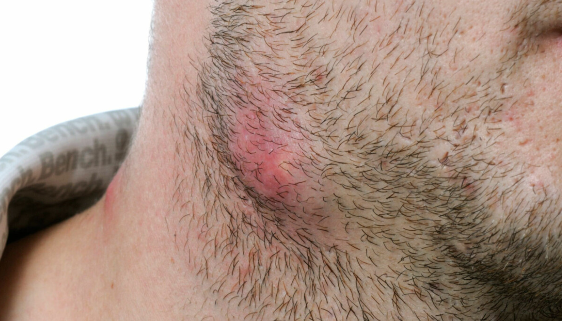 Nærbilde av rødt, hovent område på halsen – typisk for verkebyll.