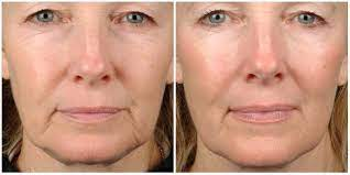 Thermage Skin Tightening Treatments - MD SPA