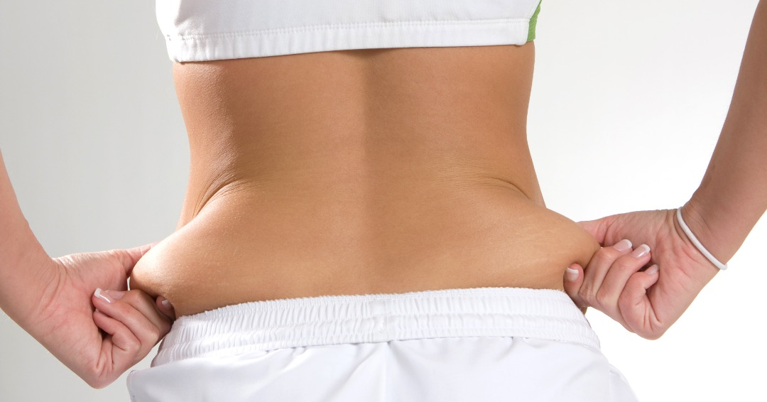 Una persona con suficiente exceso de grasa corporal para un procedimiento de levantamiento de glúteos brasileño (BBL)