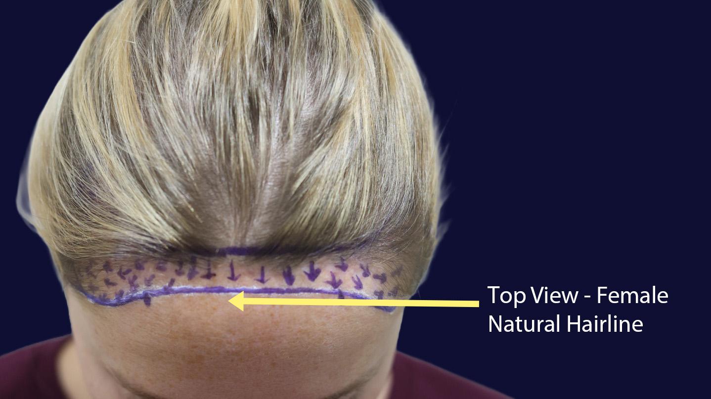 Dr Kunnure Clinic - Female Natural Hairline