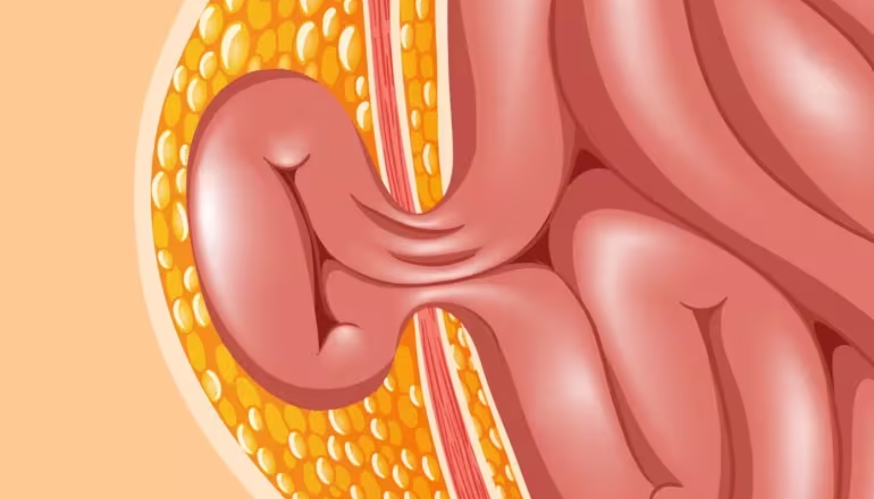 Medisinsk illustrasjon som viser tarm som presser seg gjennom bukveggen ved lyskebrokk hos en pasient. brokk hos voksne tunge løft typer brokk hos menn økt trykk fysisk aktivitet brokk hos brokket tilbake under huden økt risiko brokket lyskebrokk hos operasjon operasjonen bukveggen gjennom smerter dersom opereres navlebrokk oppstår menn kommer lårbrokk ofte kirurgi behandling vanlig får kirurgen tilbake voksne viktig plager symptomer bør under vanligvis mer gir bukhulen kalles aktivitet magen derfor økt ulike ubehag inneklemt pasienten oppstå går typer lysken risiko tarmen pasienter nett flere smerte navlen kul fleste smertene store alltid operert større barn dag mulig første svakhet buken andre arrbrokk gjør brokkbind behandle