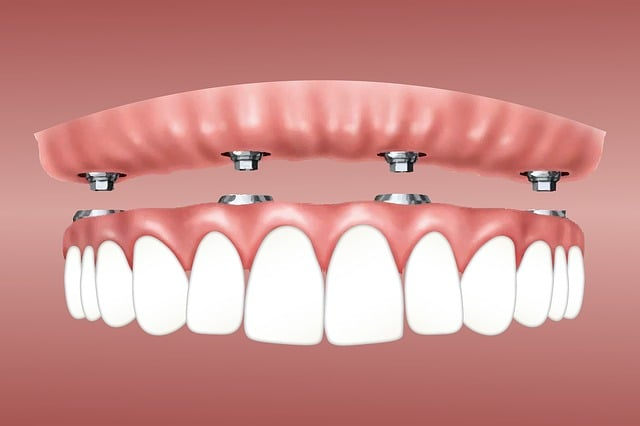 Lacking Jaw Bone? – All On 4 Dental Implants