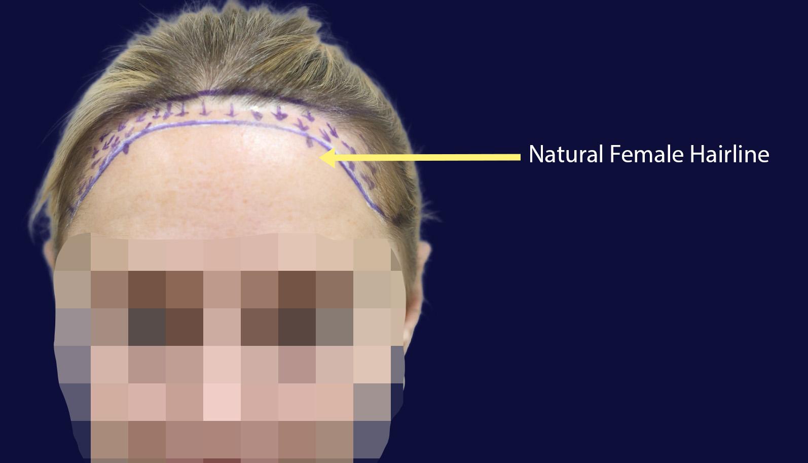 Dr Kunnure - Hair Transplant - Female Hairline