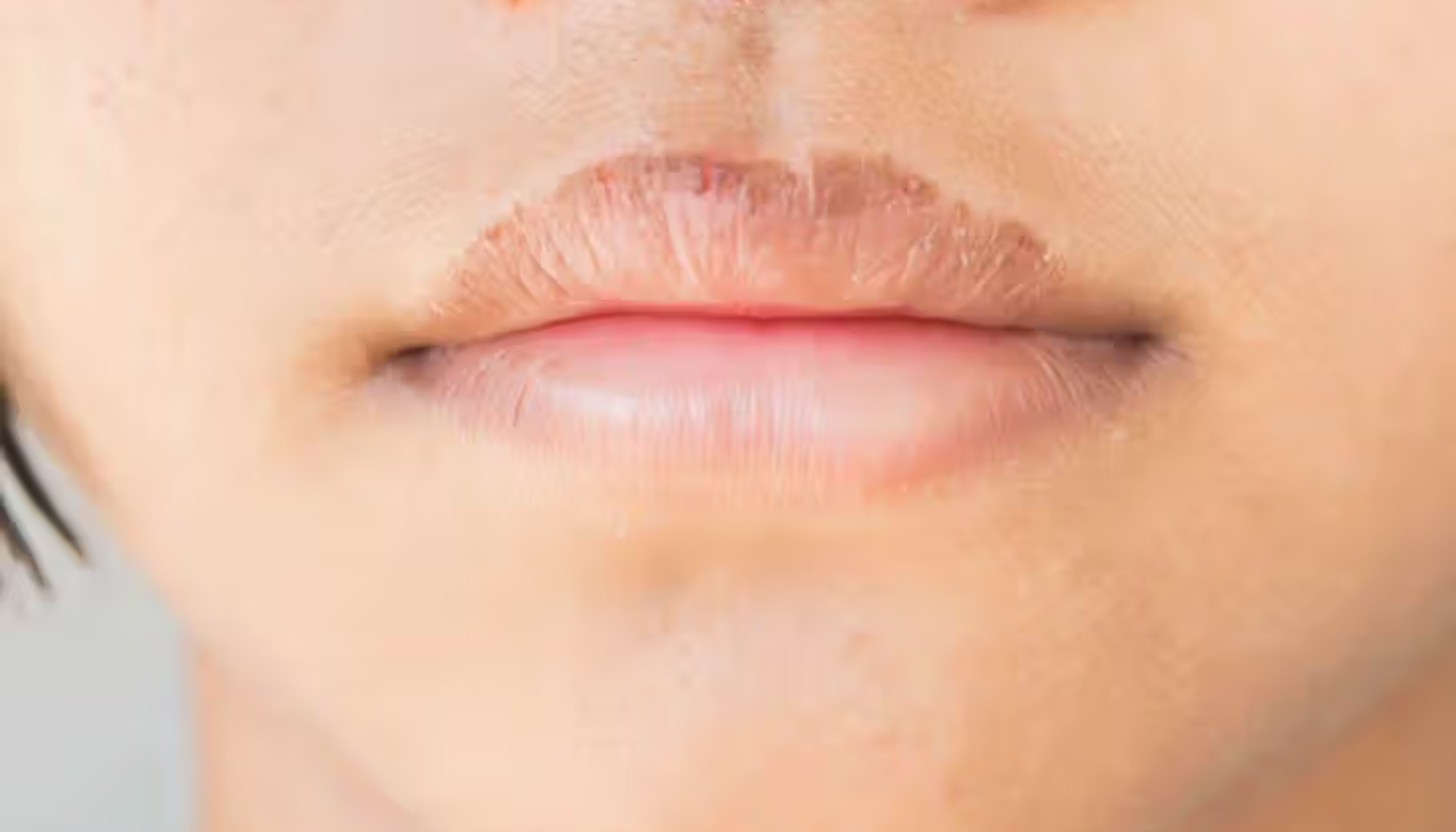 Nærbilde av munn med tørre, sprukne lepper og irritert hud som viser tegn på mulig munnproblem.