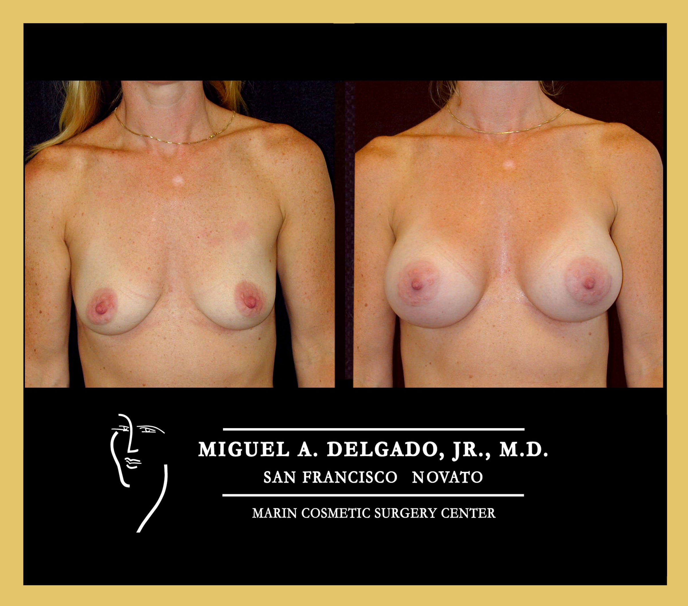 A patient of Dr. Delgado before and after silicone breast augmentation at 6 months.