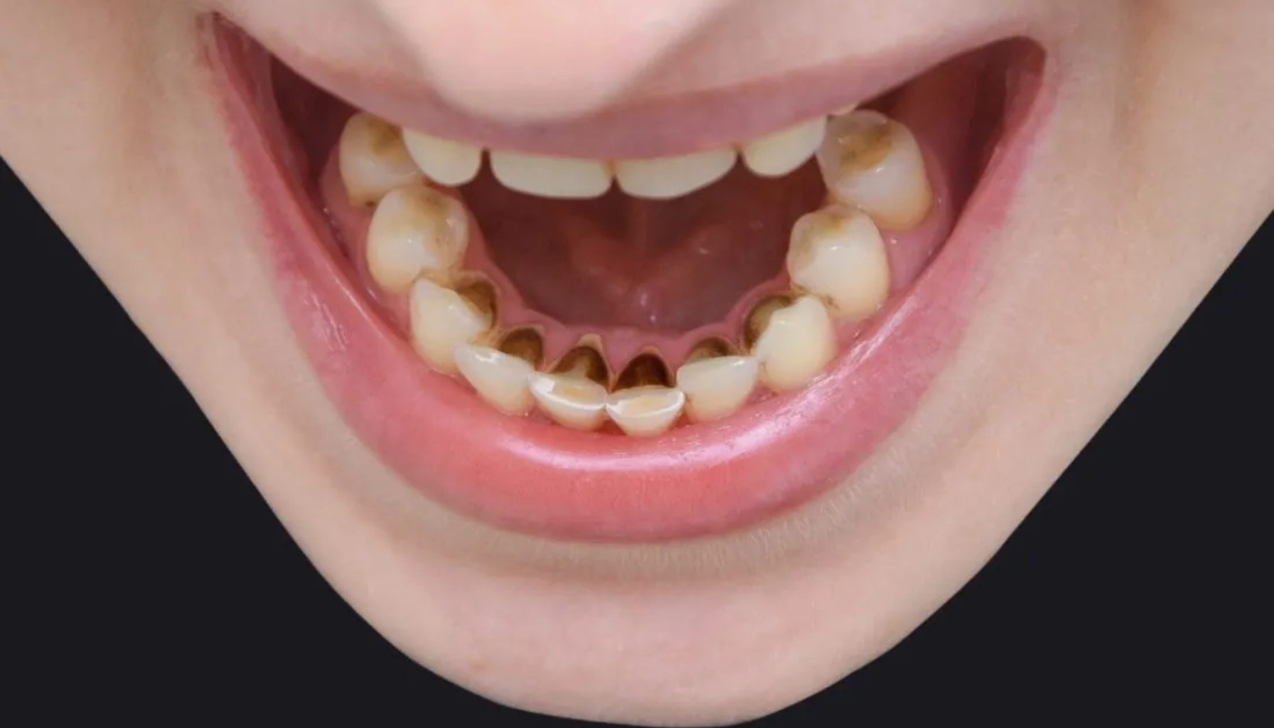 Svart tannstein – hva er det, og bør du være bekymret?