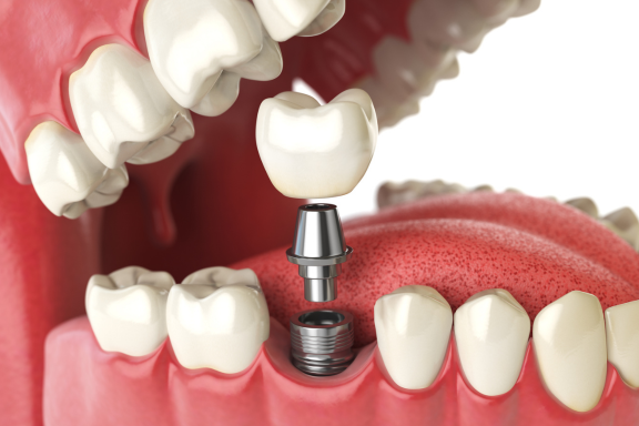 Illustration showing the components of a dental implant including titanium post, abutment and dental crown