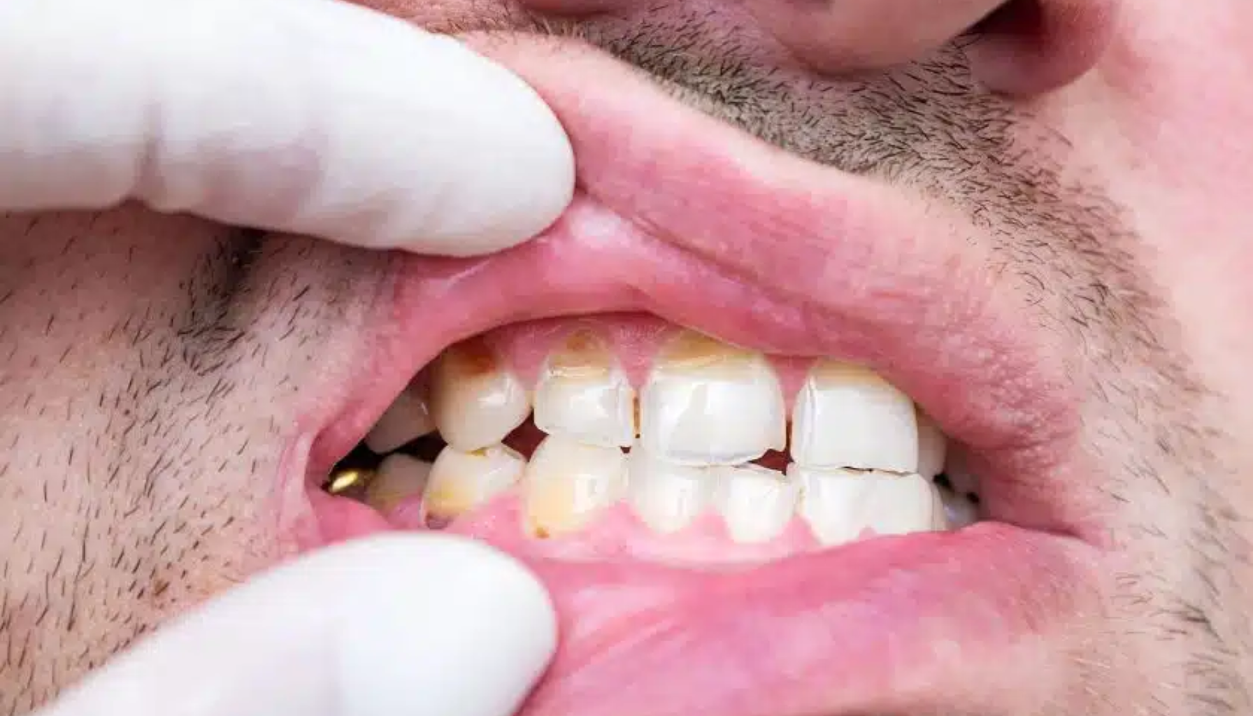 Undersøkelse av tenner med misfarging og plakk forårsaket av erosjon.