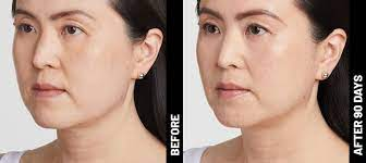 Before & After | Brow, Neck, Upper Chest & Chin Lift | Ultherapy